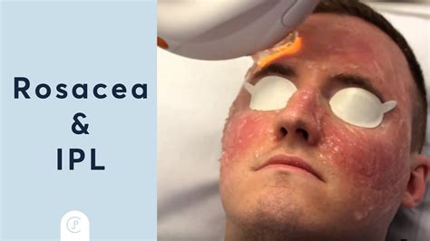 Rosacea Treatment At Pulse Light Clinic London Youtube