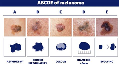 Abcdes Of Skin Cancer Detection