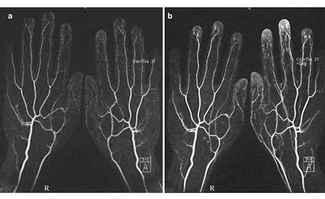Figure 2 From Bilateral Ce Mr Angiography Of The Hands At 30 T And 15