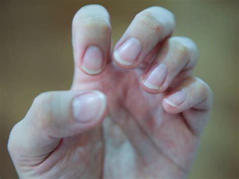 We did not find results for: External Hemorrhoids - cure hemorrhoids holistically