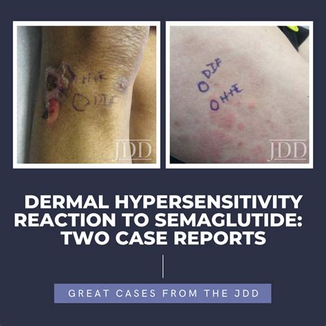 Dermal Hypersensitivity Reaction To Semaglutide Two Case Reports