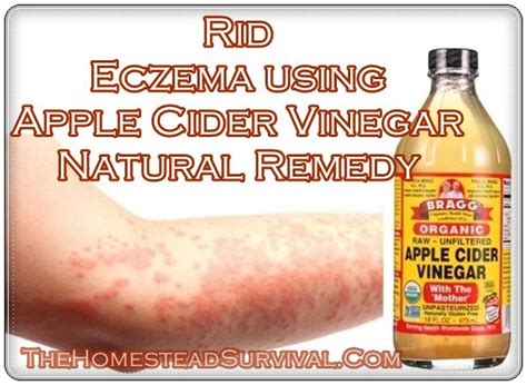 How To Get Rid Eczema Using Apple Cider Vinegar As A Natural Remedy