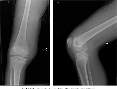 Figure 1 From Hoffas Fracture Of The Medial Femoral Condyle In A Child
