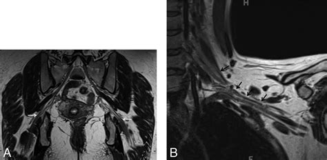 High Resolution Mr Neurography Of Diffuse Peripheral Nerve Lesions