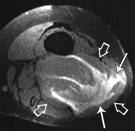 Imaging Of Musculoskeletal Liposarcoma With Radiologic Pathologic
