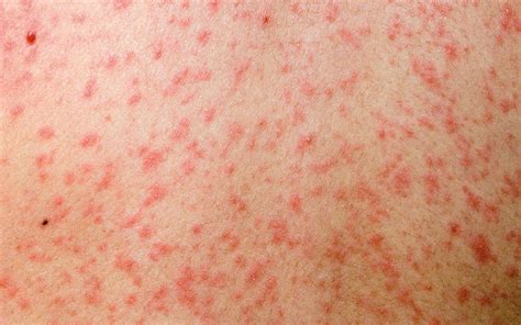 Measles Clinical Review Gponline