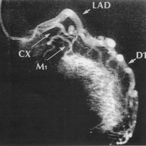 Selective Coronary Arteiography 30° Right Anterior Oblique View