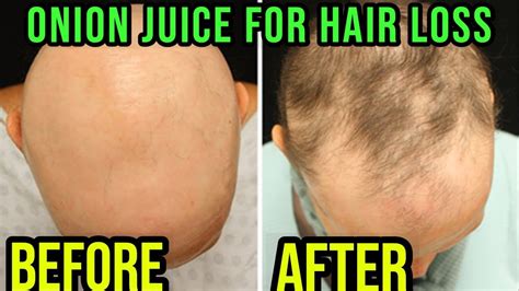 Onion Juice For Hair Regrowth Best Hair Loss Treatment Youtube