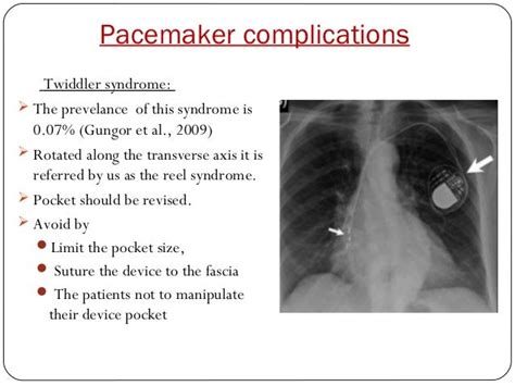 Why Rehab After Pacemaker Implant