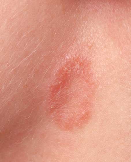 Jock Itch Ringworm Of The Groin Tinea Cruris Symptoms Causes