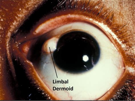 Moran Core Conjunctiva