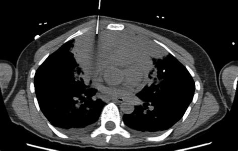 Primary Mediastinal Large B Cell Lymphoma A Review For Radiologists Ajr