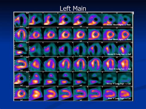 Nuclear Imaging In Cardiology Cme