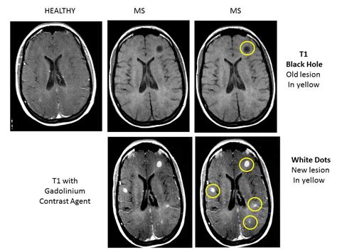 Multiple Sclerosis Research Education Whats An Mri