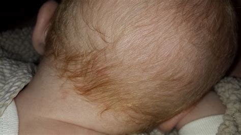 A Red Dot On The Back Of Babys Head Pic Babycenter