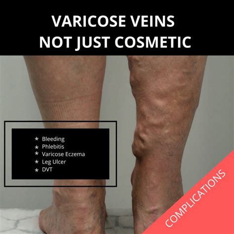 Are Varicose Veins Cosmetic The Veincare Centre
