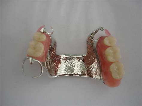 Distal abutments) or financial limitations. Vitallium 2000 cast metal partial | Partial denture ...