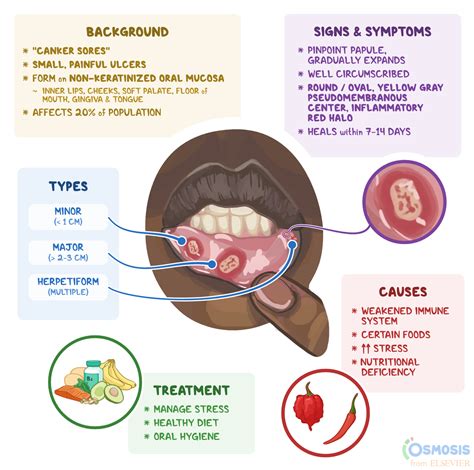 Aphthous Stomatitis What Is It Symptoms And More Osmosis