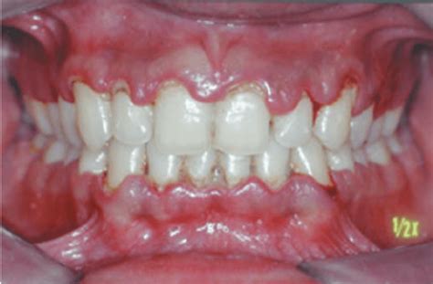 Review Of How To Drain A Periodontal Abscess At Home 2022