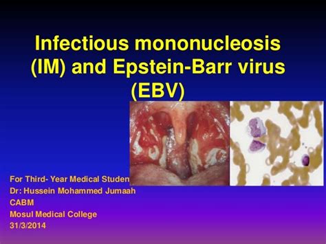Infectious Mononucleosis Im And Epstein Barr Virus