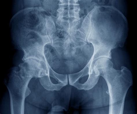Osteoarthritis Of The Hip Photograph By Zephyrscience Photo Library