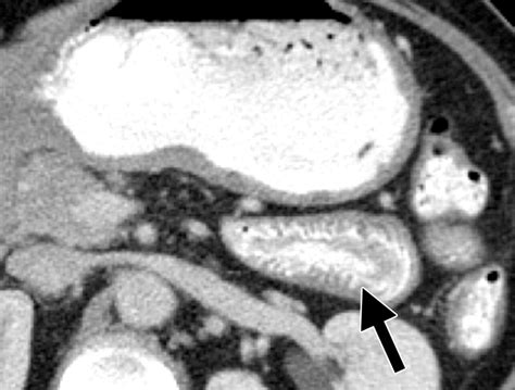 Ct Findings In Adult Celiac Disease Radiographics