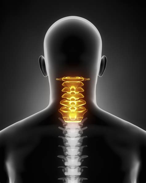 Whats Involved In Anterior Cervical Discectomy And Fusion Spine