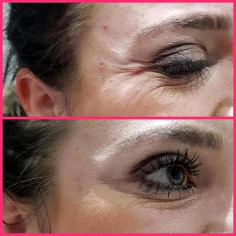 Botox For Crows Feet Before And After