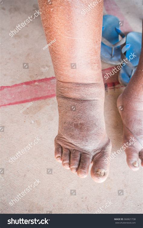 Foot Swelling On Diabetic Nephropathy Foto Stock 360821738 Shutterstock