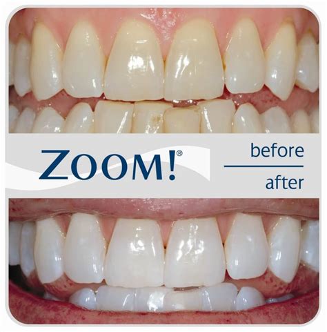 Zoom Teeth Whitening Costs And Reviews The Dental Guide