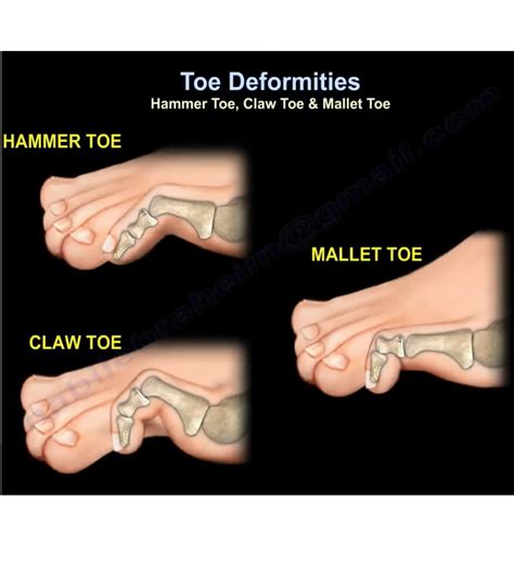 Toe Deformities Hammer Toe Claw Toe Mallet Toe —