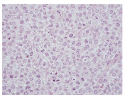 Mesothelioma can be categorized histologically as epithelioid type, sarcomatoid type, biphasic type, desmoplastic type, among others. Metastatic malignant mesothelioma to lymph node. The tumor ...