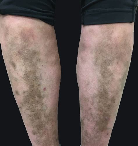 Lower Leg Hyperpigmentation In Myh9 Related Disorder Mdedge Dermatology