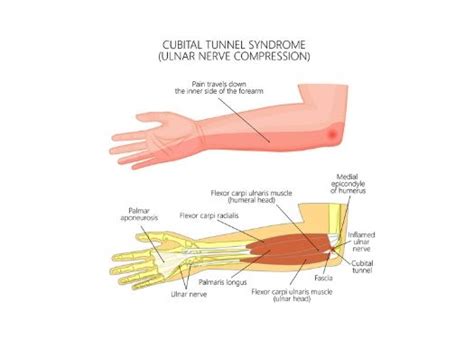 Cubital Tunnel Syndrome Ulnar Nerve Neuritis