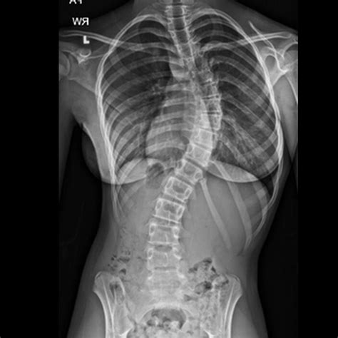 Scoliosis The Sideways Spinal Curve That Could Be Causing Your Uneven Shoulders And Hips