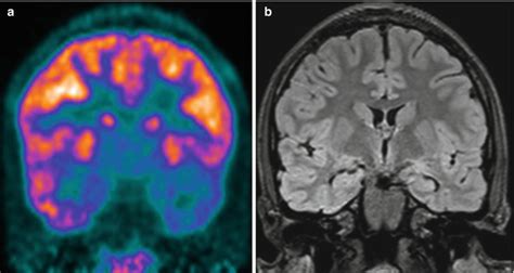 Petct In The Clinical Evaluation Of Pediatric Epilepsy Radiology Key