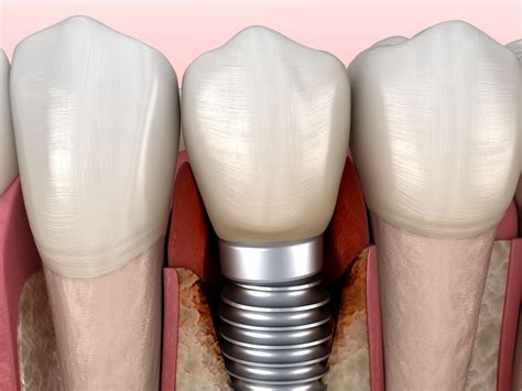 How To Prevent Dental Implant Failure Digital Denture Implants