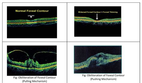 What Is Optical Coherence Tomography Oct Basic Interpretation