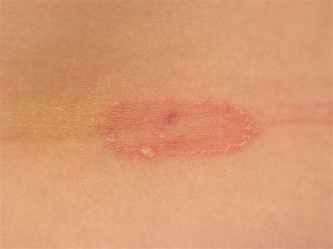 Show Images Of Ringworm Ringworm Is A Common Fungal Infection Go