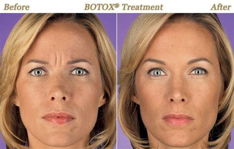 Botox Radiesse And Restylane Lip Filler Injections Before And After