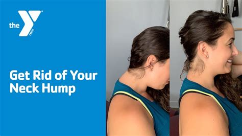 Get Rid Of Your Neck Hump Youtube