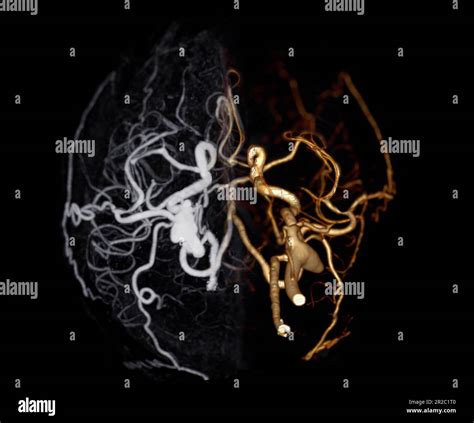 Ct Angiography Of The Brain Or Cta Brain Showing Cerebral Artery Stock