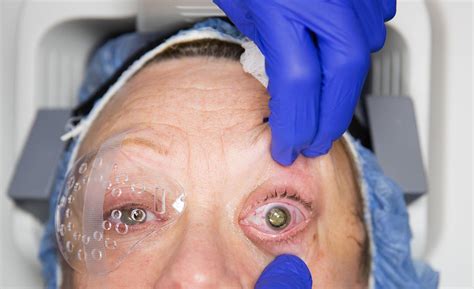 new type of lens implant adds an ‘exciting twist to the business of cataract surgery