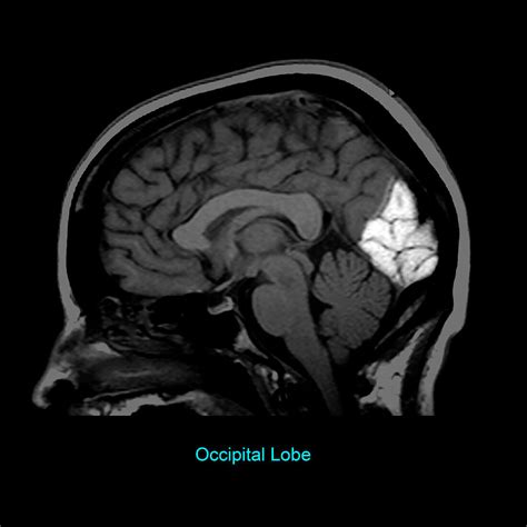 Occipital Lobe Sagittal Mri Bild Kaufen 12628697 Science Photo Library
