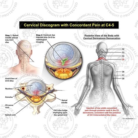 Female Central Cervical Discogram With Concordant Pain At C4 5