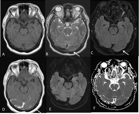 Bickerstaff Brainstem Encephalitis With Guillain Barré Syndrome Overlap