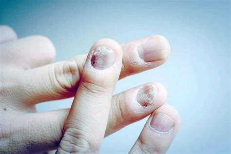 Nail Yeast Infections We Heart Nails