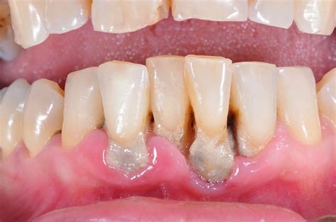 Periodontitis síntomas tratamiento y contagio Directorio Odontológico