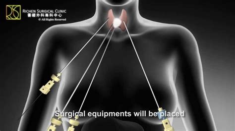 Thyroid Surgery Thyroid Removal Surgery Goiter Surgery Richen