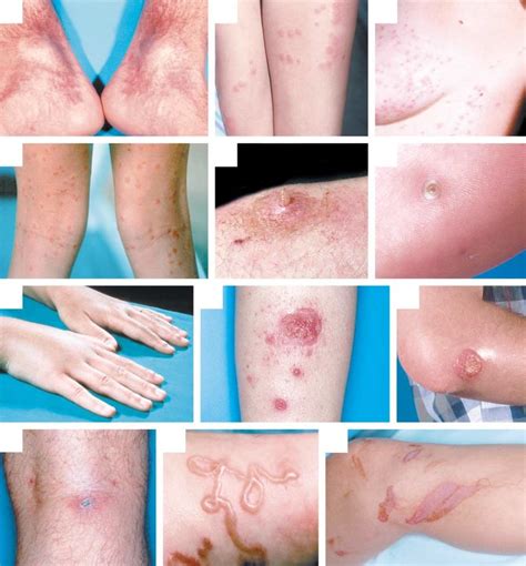 Common Dermatologic Lesions In Travelers Returning From Developing